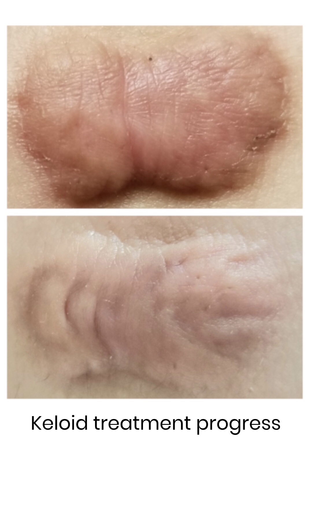 Natural Scar Care: Hei Ba Gao Keloid Treatment Masque 120ml - Image 5